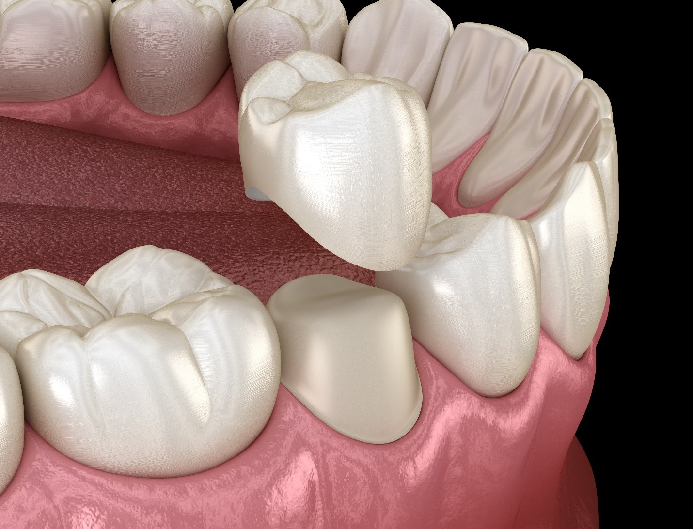 4 Signs You May Need to Replace Your Dental Crown