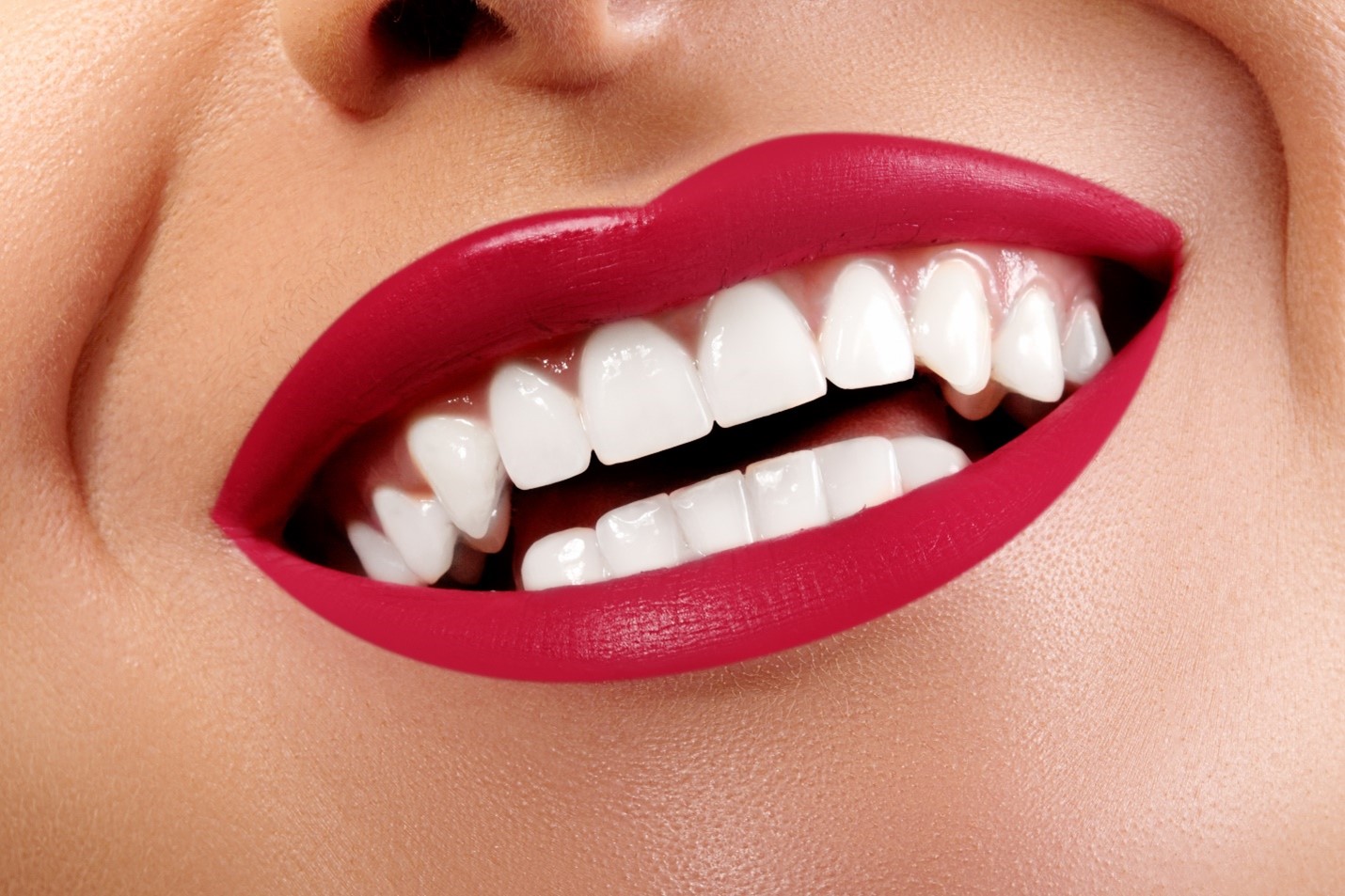 9 Remarkable Benefits Of Dental Veneers